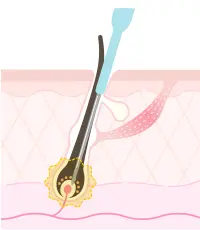 ニードル脱毛画像